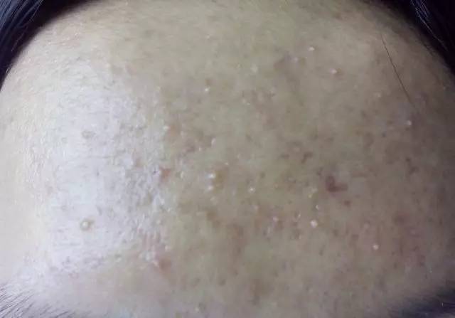 战痘｜史上最全”战痘“解答50+合集！