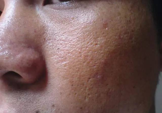 最全战痘攻略,战痘100种祛痘方法