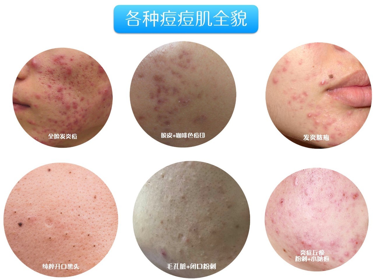 战痘大结局完整版,战痘合集完整版