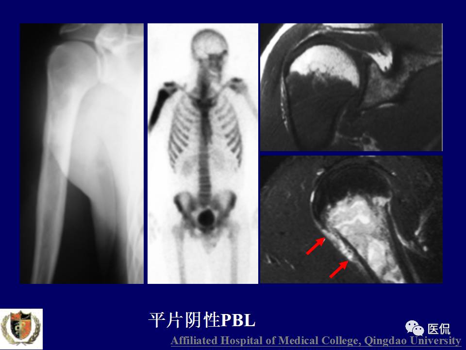 徐文坚老师精讲：原发性骨淋巴瘤影像学诊断医学影像精品PPT