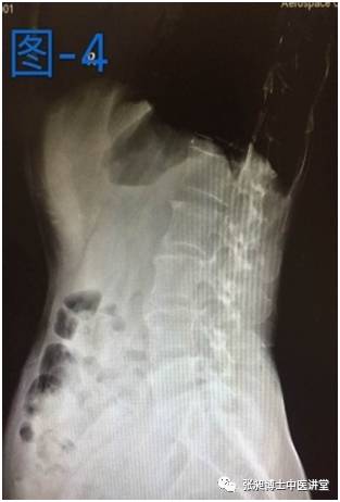 小针刀治疗脊柱侧弯,腰椎间盘突出脊柱侧弯的针刀治疗