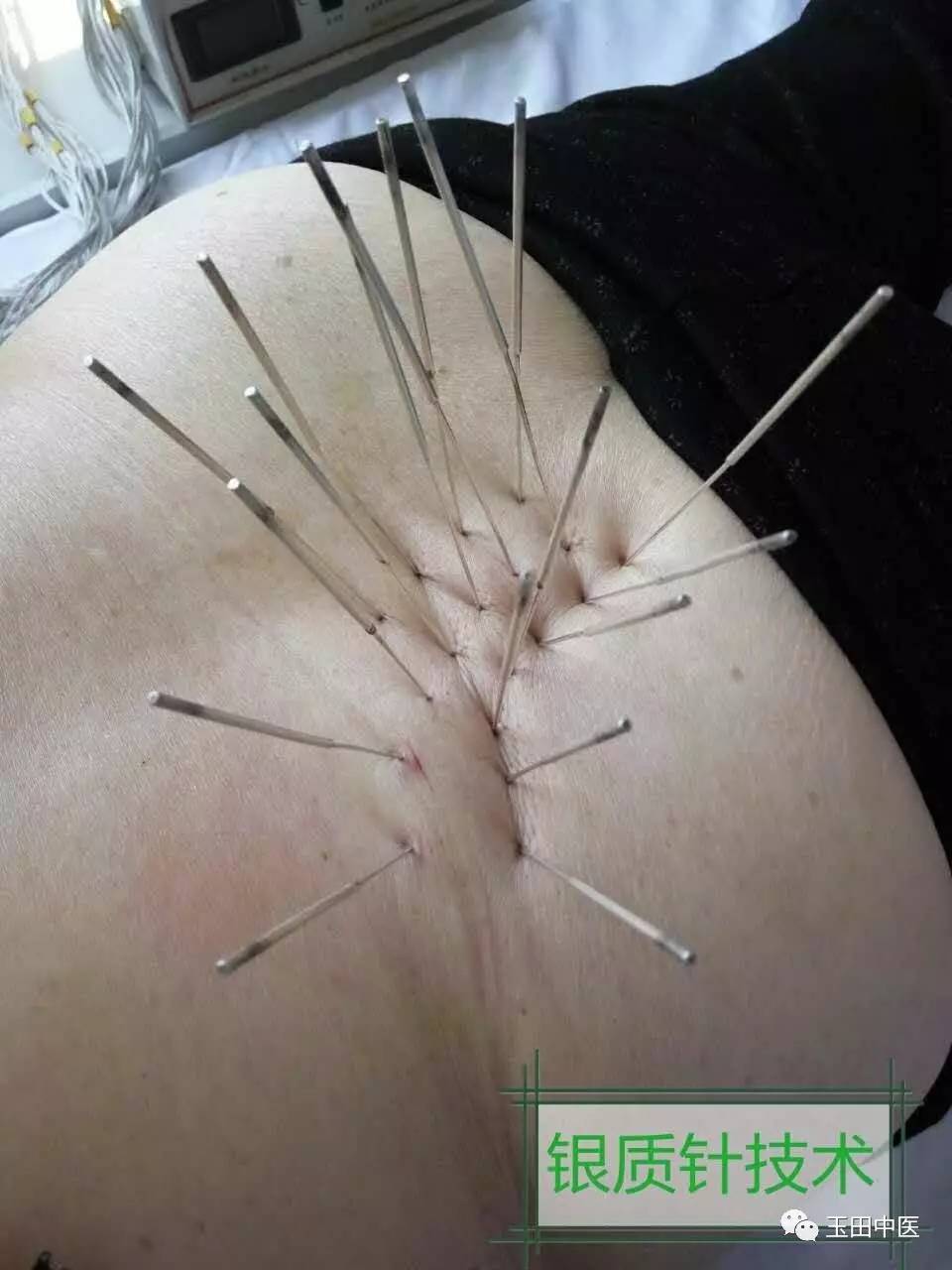 疼痛科最佳诊断,疼痛科专用器械大全