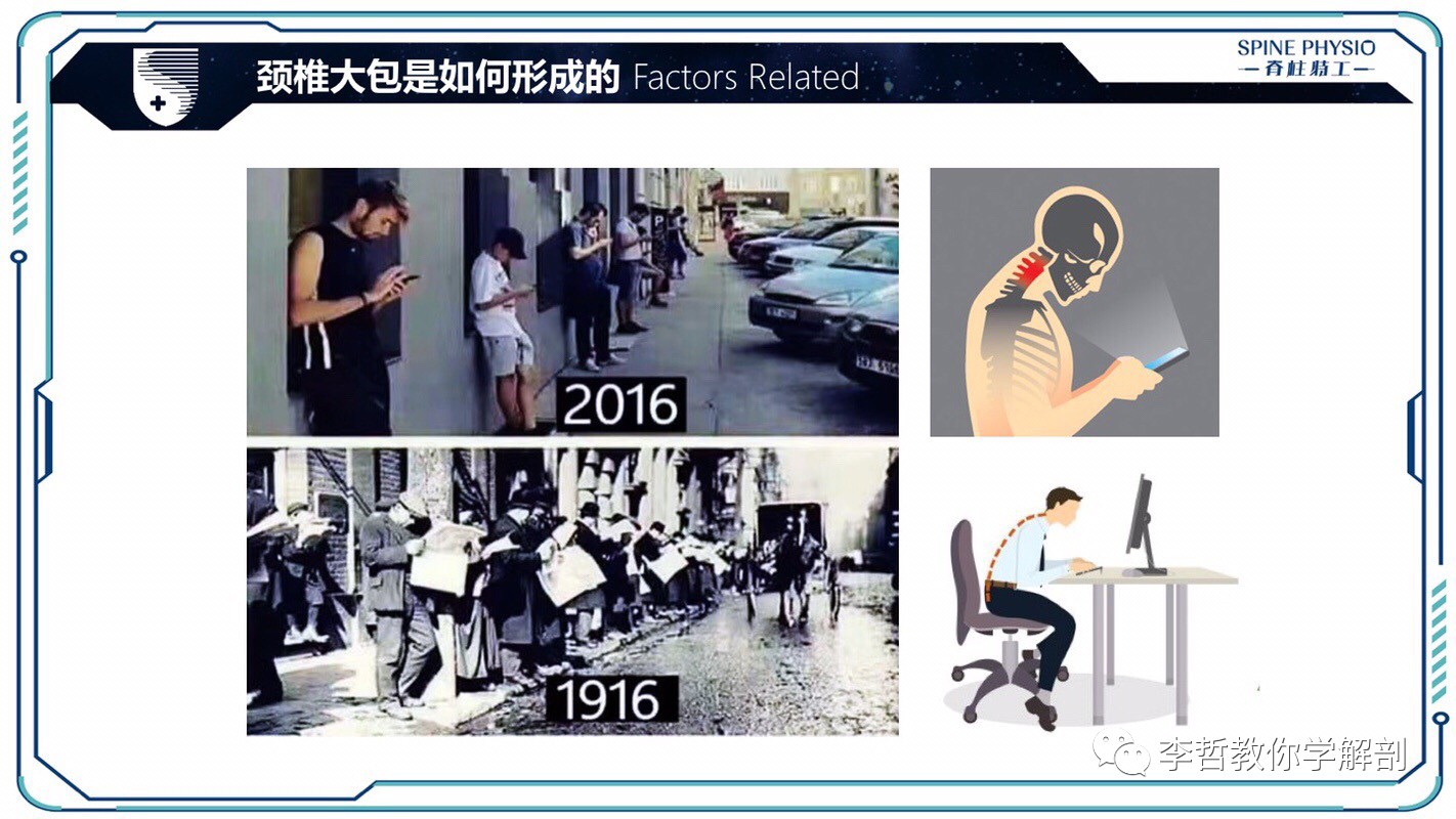 24度颈部大包怎么去除,颈后大包通过训练消除