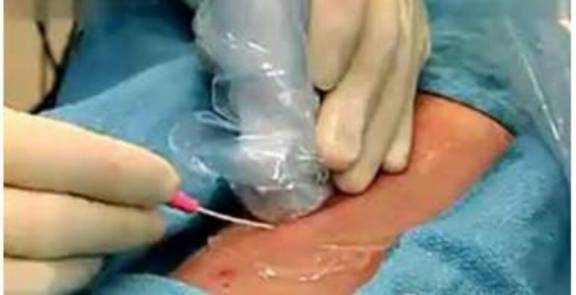 「护理宣教」小小穿刺针，实时报血压