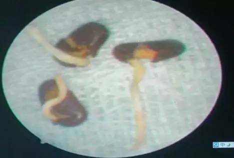 4岁男孩把黄豆塞进耳朵,小男孩把豆子塞耳朵里了