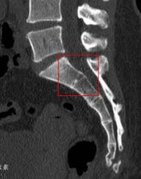12胸椎爆裂性骨折截瘫恢复案例,一位阿姨因为骨折瘫痪多年