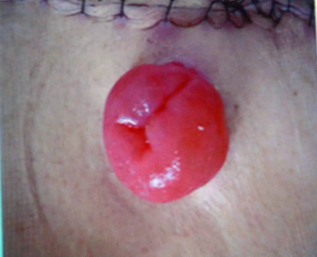 肠造口常见周围皮肤并发症,肠造口护理操作并发症