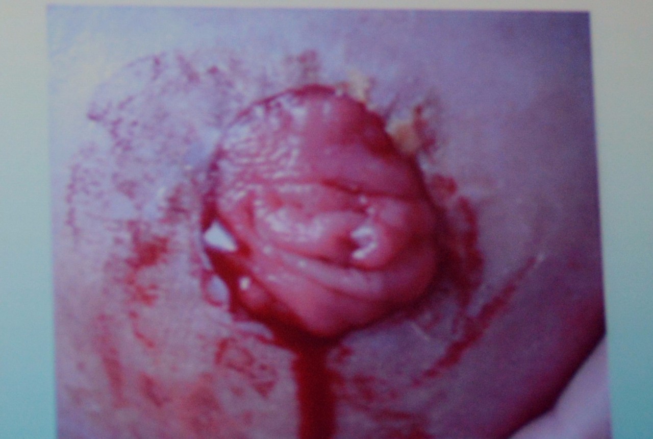 肠造口回纳的并发症是什么,膀胱全切肠造口有什么并发症