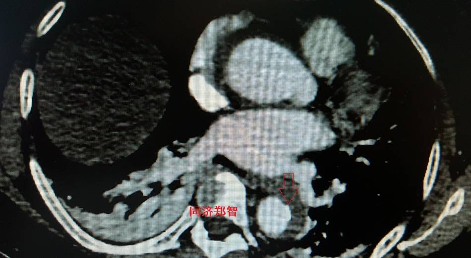 急性主动脉夹层cta影像诊断与鉴别,冠状动脉cta可以看到主动脉夹层吗