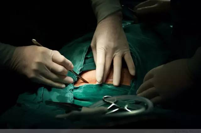 剖腹产全景记录,剖腹产恢复不同时期的照片