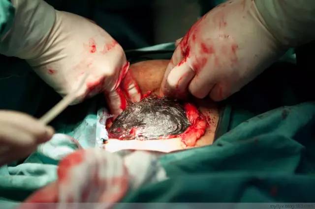 剖腹产全景记录,剖腹产恢复不同时期的照片