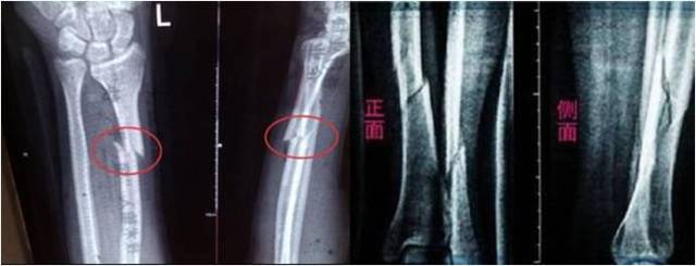 骨折复位后局部断端成角,骨折断端稍错位能恢复吗