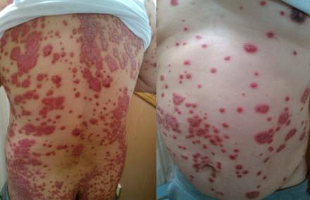 顶尖银屑病专家,10月28号世界银屑病日健康讲座