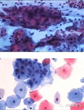 宫颈刮片多久可以拿报告,宫颈刮片图片报告单