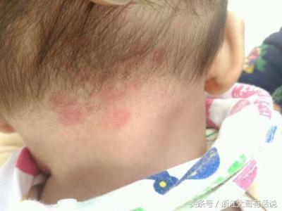 宝宝胎记为何“同记不同命”是因为你陷入了这几个误区