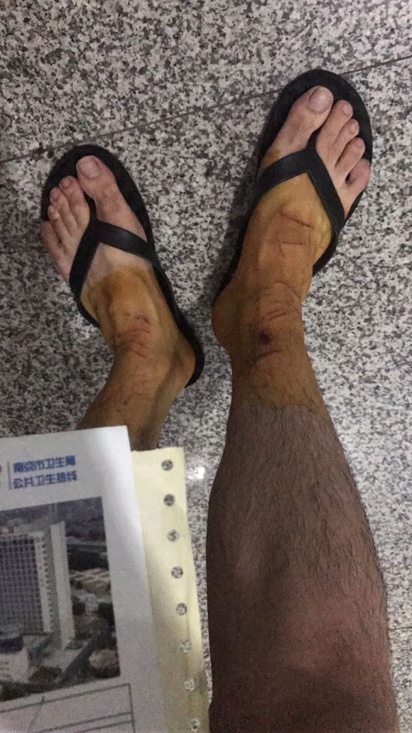 男子晒出被猫妈抓挠的伤痕，网友看后一阵大笑：没咬你算轻的！