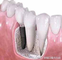 拔牙后镶牙的最佳时间,拔牙后镶牙最佳时间表