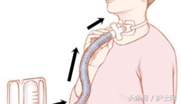 气管切开病人的护理措施存在问题,气管切开卧床病人的三大并发症