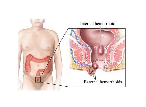 女性痔疮做手术后复发怎么办,女性做了痔疮手术后怎么调理