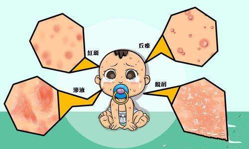 婴儿湿疹快速消除的办法,婴儿湿疹怎么办三个妙招来解决