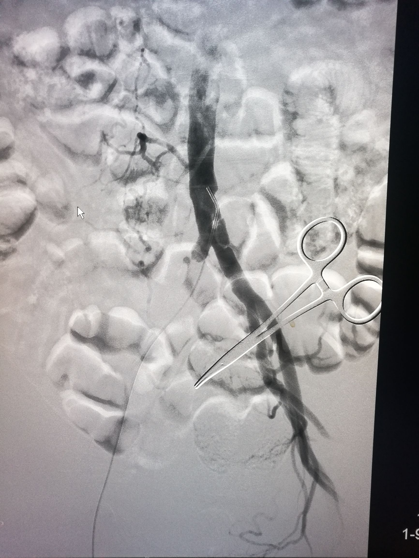 治下肢血栓闭塞脉管炎中药方,下肢动脉慢性血栓闭塞