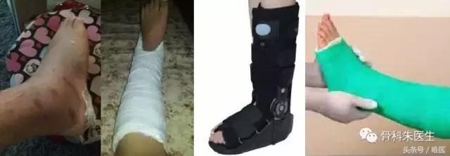 骨科脚踝扭伤怎么快速恢复,医生会怎么处理脚踝扭伤