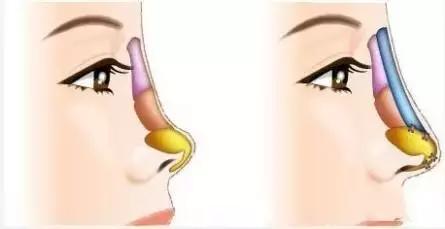 鼻子不好看的女性,线雕鼻做好鼻梁太细是什么原因