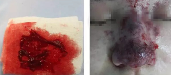 打玻尿酸隆鼻一年了鼻梁变宽,注射玻尿酸隆鼻7年还吸收不了