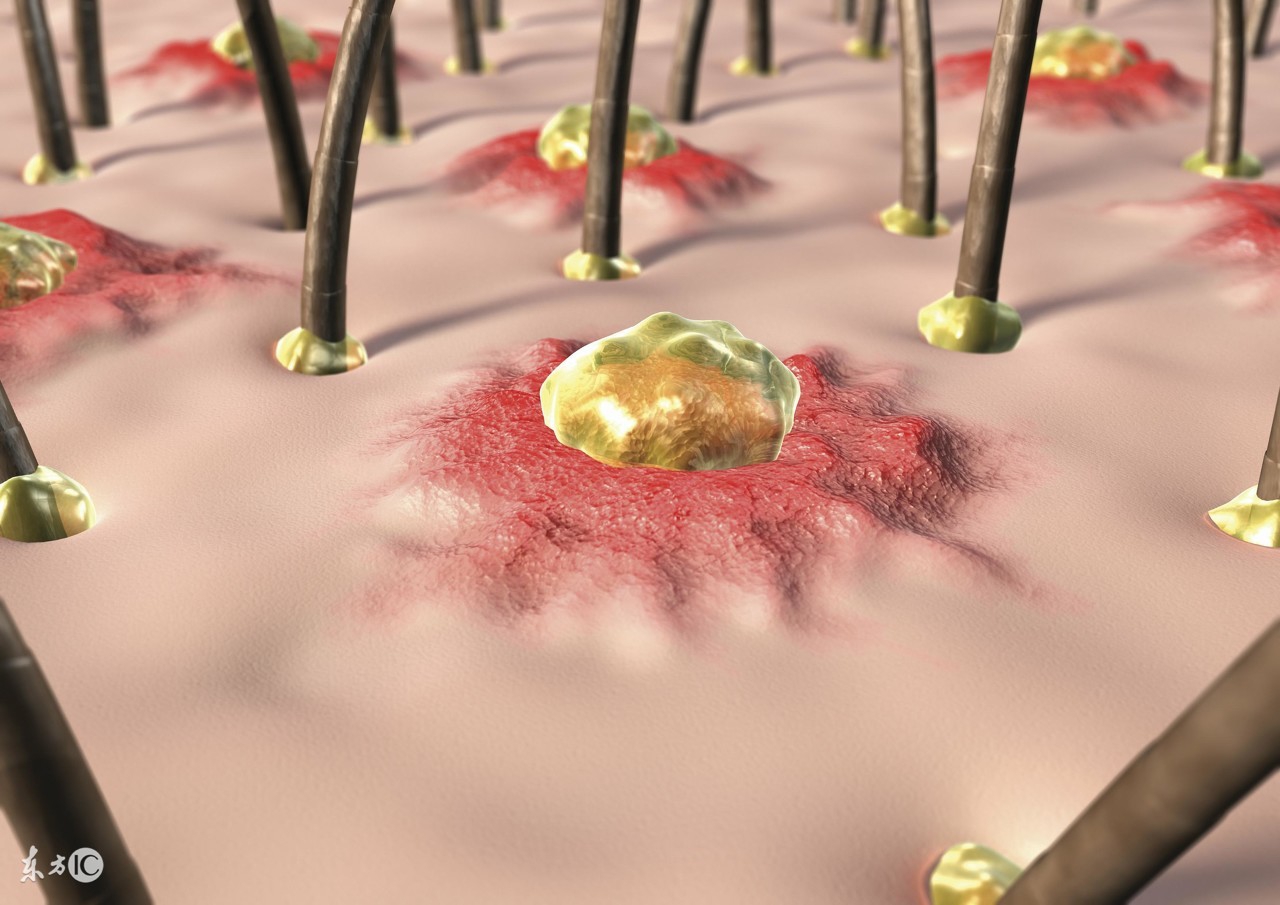 如何修复毛孔粗大和痘坑,痘坑痘印毛孔粗大的区别