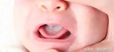 清理宝宝舌头奶渍能预防鹅口疮吗,宝宝鹅口疮治疗和预防攻略
