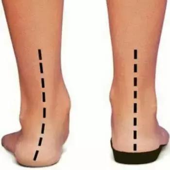 针灸治疗脊柱侧弯的最好方法,脊柱侧弯如何治疗才正确有效