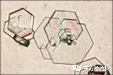 孕妇尿结晶数值多少是结石,尿结晶数量高看什么科