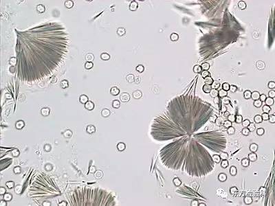 孕妇尿结晶数值多少是结石,尿结晶数量高看什么科