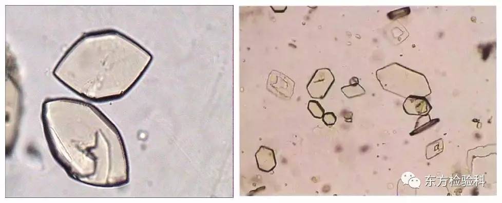 孕妇尿结晶数值多少是结石,尿结晶数量高看什么科