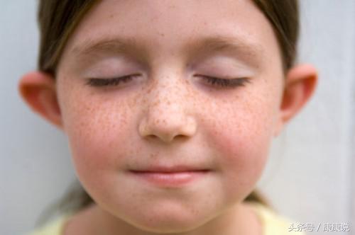褐青色斑选择什么方法祛好点,褐斑的成因