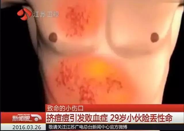 男子后脑勺长了几个疙瘩,男子颅内长活虫