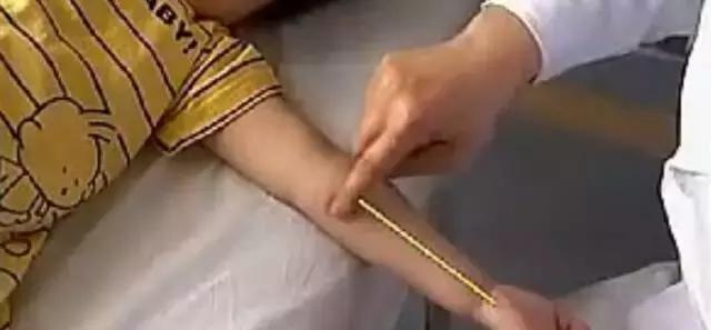 孩子湿疹怕用药有激素,不妨试试这几个穴位