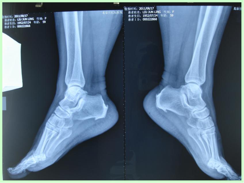 足跟突然疼痛是什么原因引起,为什么早上起来足跟痛
