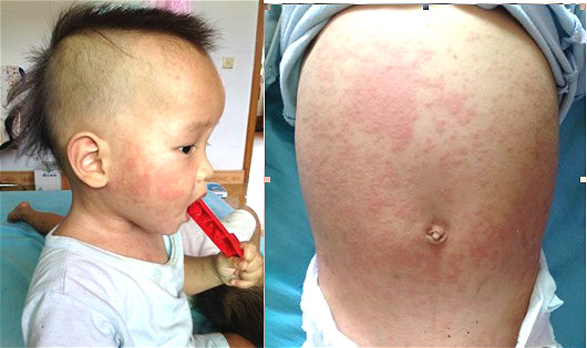 幼儿急疹出现的高热惊厥,幼儿高烧39度惊厥