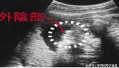 生男生女不求人,b超怎么看出胎儿姓名