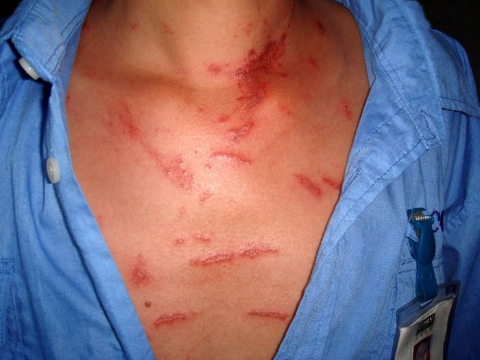 夏天咬人毒虫有哪些,被毒虫咬一般什么虫子