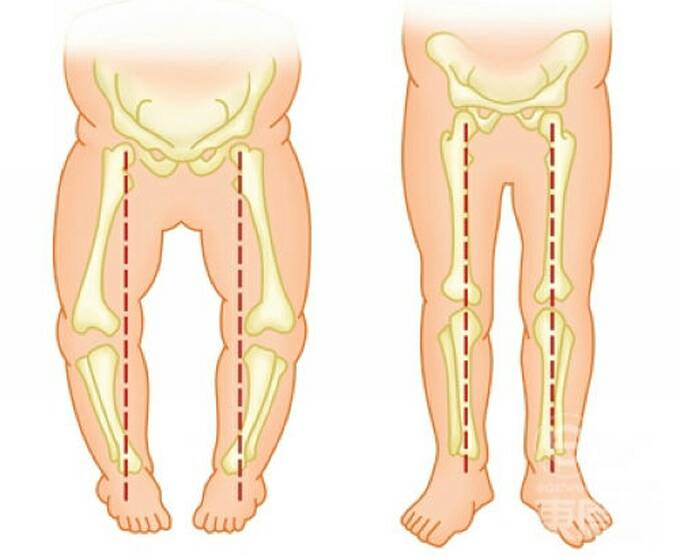 外旋型o型腿哪种矫正方式最有效,宝宝为什么会o型腿