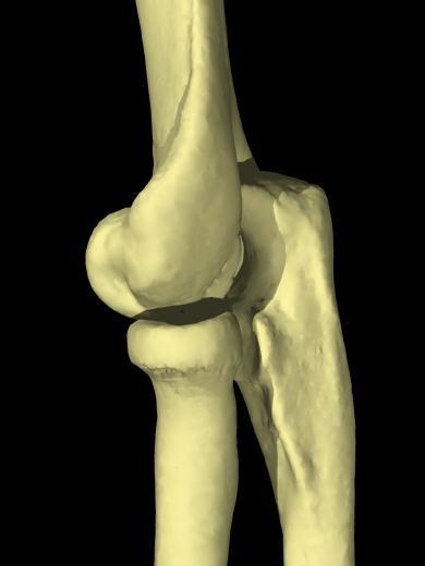 4岁左桡骨小头骨皮质断裂,小孩桡骨小头发育缺失