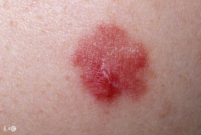 丘疹怎么护理才好得快,丘疹有什么危险