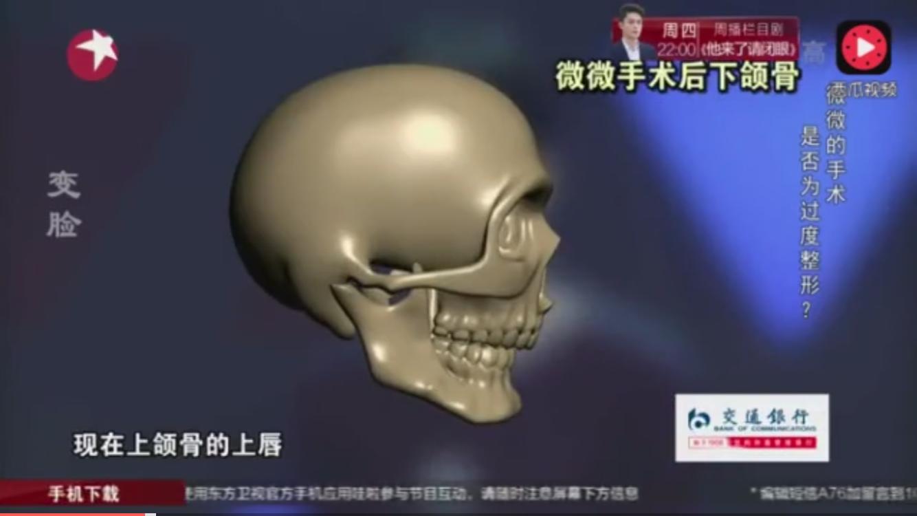 韩国整形手术有多可怕,韩国整形最难做的手术