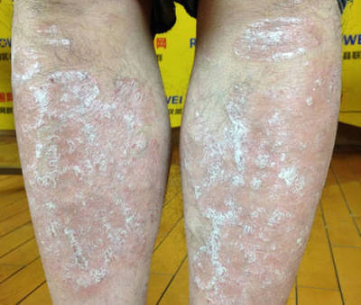 银屑病难治?用对药就简单,试试这种农村的野菜吧!