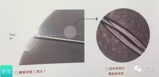 脸部缝美容线好还是普通线好,医院埋线和美容院埋线有什么差别