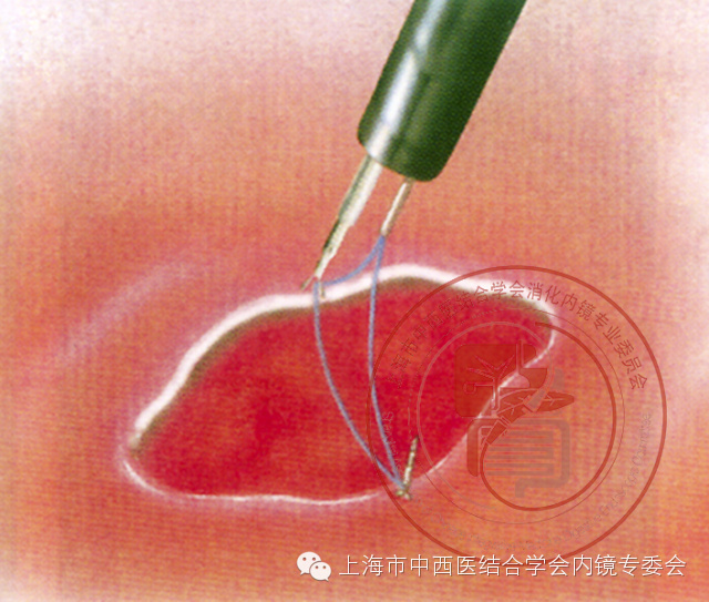 内镜套扎是什么,内镜套扎器械