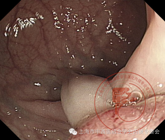 内镜套扎是什么,内镜套扎器械