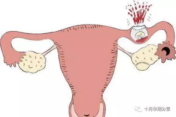 宫外孕一侧输卵切除后2年不孕,生过孩子宫外孕后不孕了怎么回事
